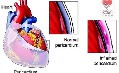 پریکاردیت چیست ؟