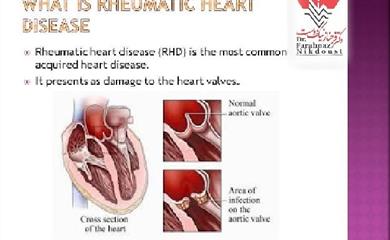 بیماری روماتیسم قلبی